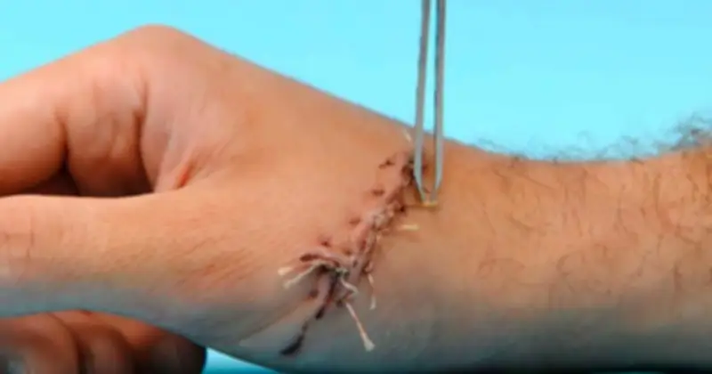 Hướng dẫn chăm sóc da sau cắt chỉ: Giai đoạn vàng để ngăn ngừa sẹo xấu