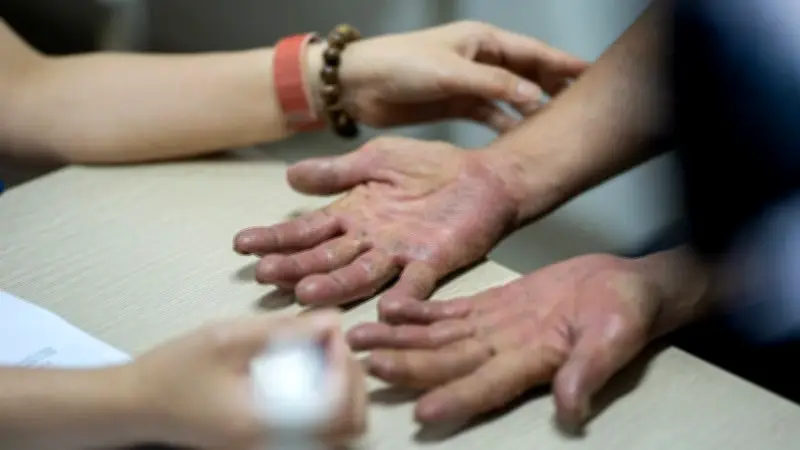 Mùa hè nắng nóng: Bùng phát các bệnh da liễu và cách phòng tránh hiệu quả