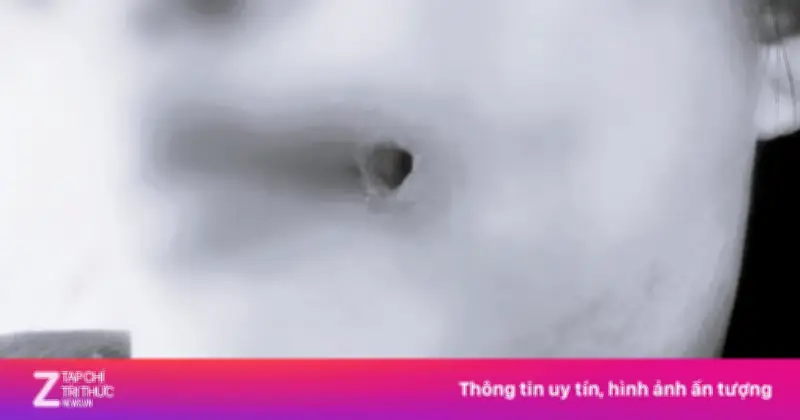 Mặt biến dạng vì tự rạch ổ mủ sau tiêm filler: Cảnh báo nguy hiểm