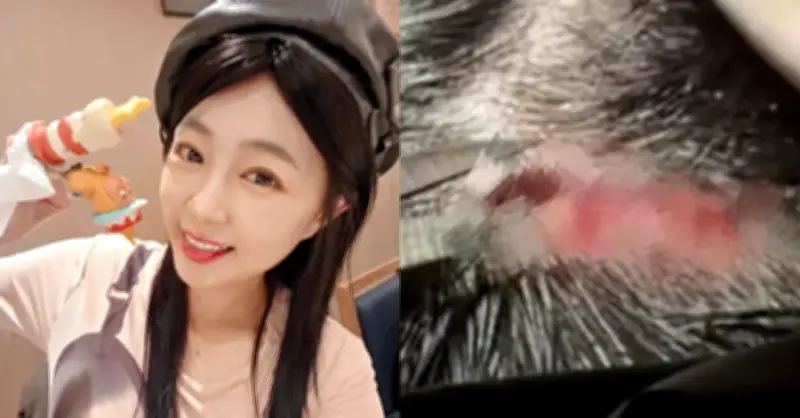 Nữ diễn viên 38 tuổi ngã đập đầu, khâu 5 mũi ngay sinh nhật