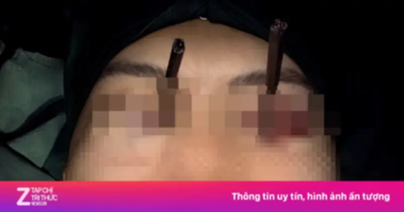 Nam thanh niên thoát chữ thần kỳ khi hai chiếc đũa đâm sâu vào hai mắt