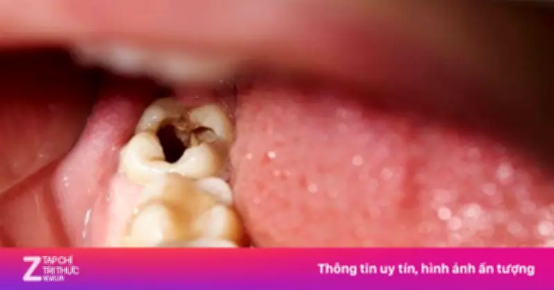 Đừng bỏ qua dấu hiệu sớm ở răng để tránh khoan hàn