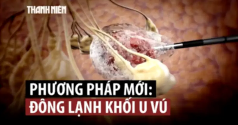 Đông lạnh khối u vú: Phương pháp mới thay thế phẫu thuật cho ung thư nguy cơ thấp