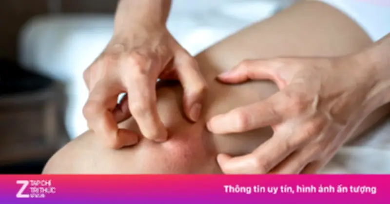 Ngứa Da Kéo Dài: Dấu Hiệu Cảnh Báo Suy Thận Thường Bị Bỏ Qua