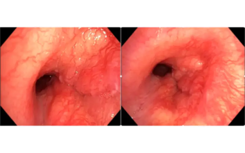 Người đàn ông 32 tuổi phát hiện ung thư phổi hiếm gặp từ dấu hiệu nhiều người Việt mắc phải
