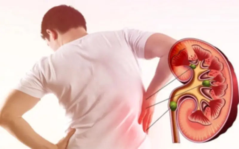 Người đàn ông 35 tuổi mắc suy thận mạn từ món ăn quen thuộc ở hàng quán