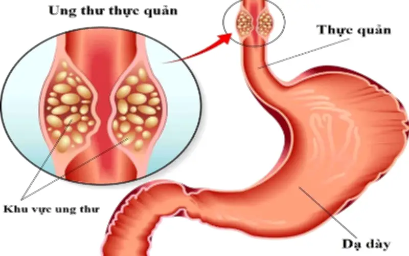 Người đàn ông 50 tuổi phát hiện ung thư dạ dày, tiền ung thư thực quản từ dấu hiệu nhiều người bỏ qua