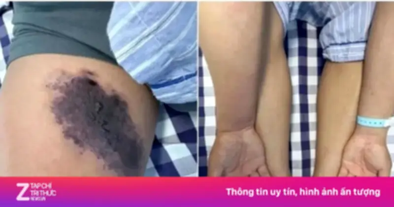 Người đàn ông bị nhện cắn gây hoại tử, nhiễm độc toàn thân sau khi mặc quần jeans cũ