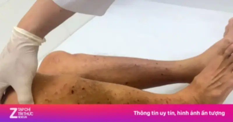 Người đàn ông Hải Phòng nhiễm cùng lúc sán dây chó và giun đũa sau hơn 2 tháng ngứa toàn thân