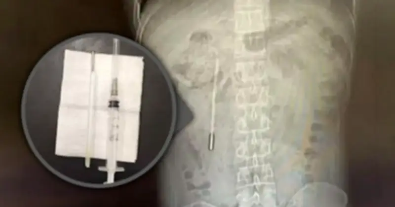 Người đàn ông phát hiện nhiệt kế thủy ngân trong bụng sau 20 năm vô tình nuốt phải