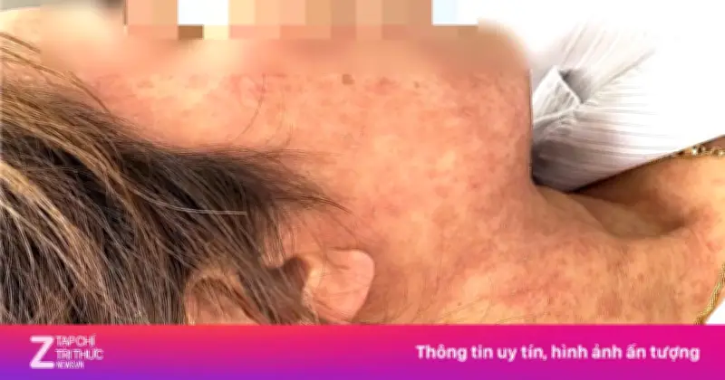 Người phụ nữ 42 tuổi nhập viện với biến chứng sởi nặng sau khi lây từ cháu