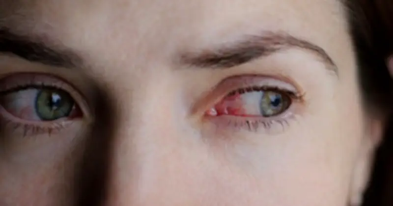 Người trẻ 24 tuổi mất thị lực vì uống trà sữa: Cảnh báo đột quỵ mắt