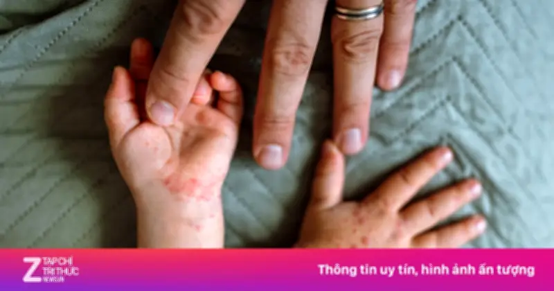 Nhận Biết Sớm Dấu Hiệu Khởi Phát Bệnh Tay Chân Miệng Ở Trẻ Nhỏ