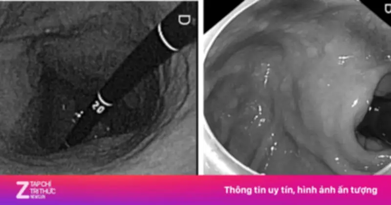 Những Thói Quen Hàng Ngày 'Tiếp Tay' Cho Ung Thư Dạ Dày Ít Ai Ngờ Tới