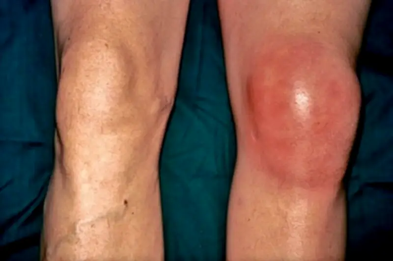 Áp Dụng Phương Pháp Dân Gian Chữa Gout, Người Đàn Ông Đối Mặt Nguy Cơ Tàn Phế