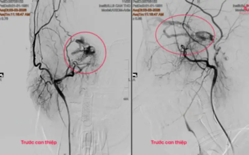 Phụ nữ 65 tuổi phát hiện dị dạng mạch máu não từ dấu hiệu nhiều người bỏ qua
