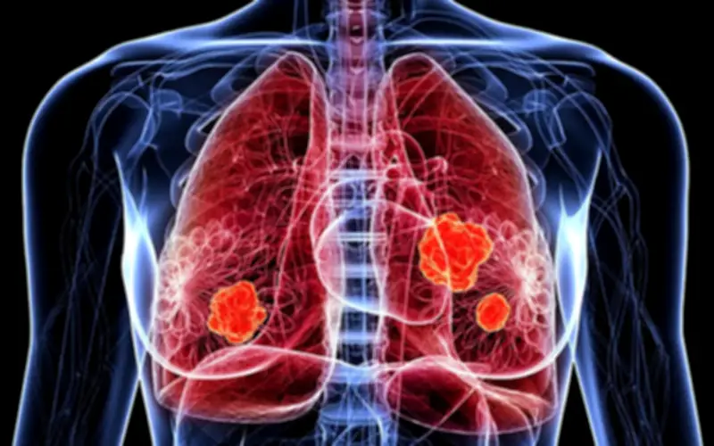Phụ nữ 66 tuổi nhập viện mới phát hiện ung thư phổi giai đoạn muộn từ dấu hiệu nhiều người bỏ qua