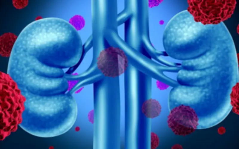 Phụ nữ 67 tuổi phát hiện ung thư thận giai đoạn sớm từ thói quen nhiều người bỏ qua