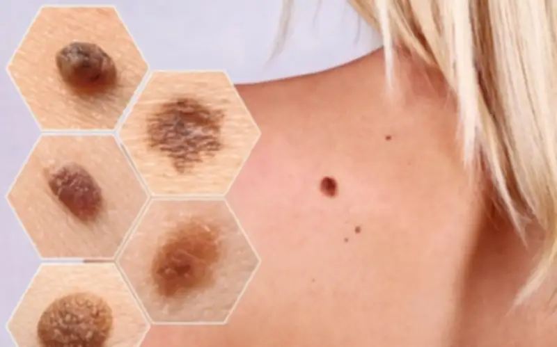 Phụ nữ phát hiện ung thư hắc tố ở cơ quan sinh dục từ dấu hiệu dễ bỏ qua sau mãn kinh