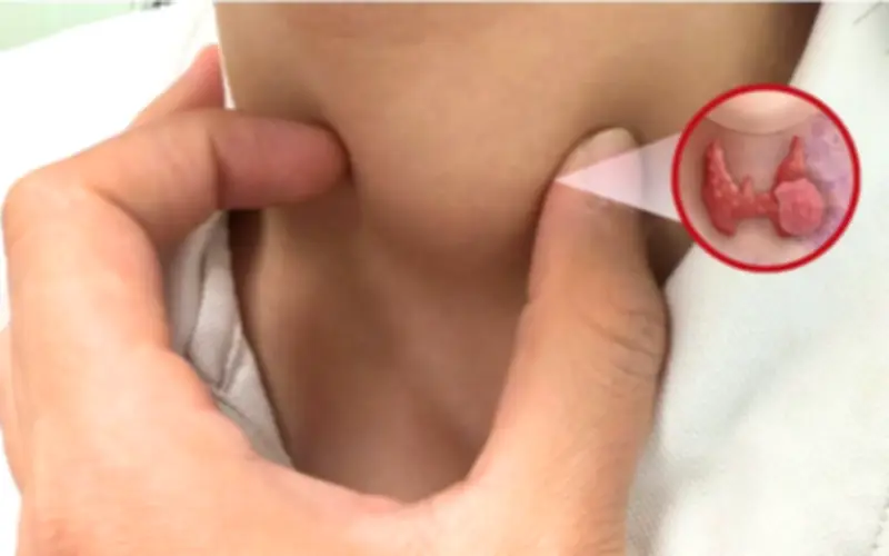 Phụ nữ phát hiện ung thư tuyến giáp từ dấu hiệu nhiều người Việt bỏ qua