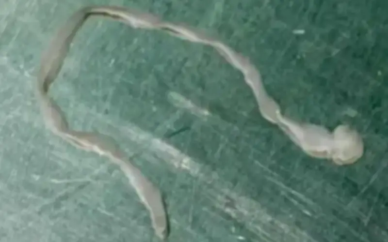 Phát hiện giun sống 8 cm trong não phụ nữ 61 tuổi sau loạt chẩn đoán sai