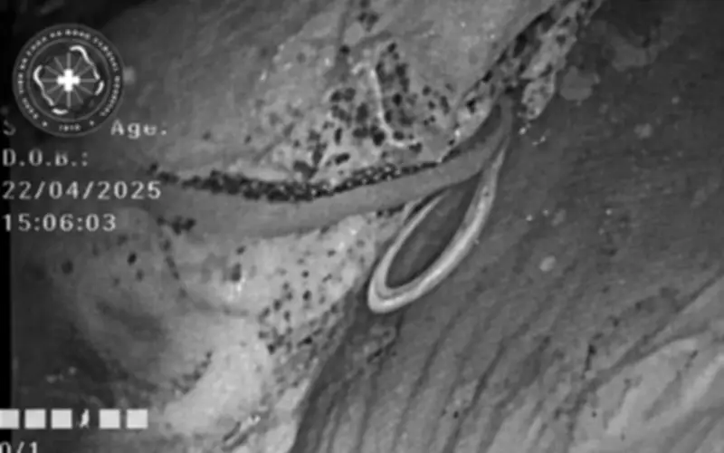 Phát hiện ký sinh trùng dài cuộn trong ruột bệnh nhân đầy bụng khó tiêu