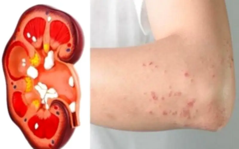 Phát hiện suy thận giai đoạn nặng từ dấu hiệu nhiều người Việt dễ bỏ qua