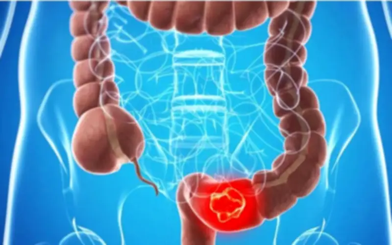 Phát hiện ung thư trực tràng từ dấu hiệu mờ hồ, nhiều người Việt vô tình bỏ qua