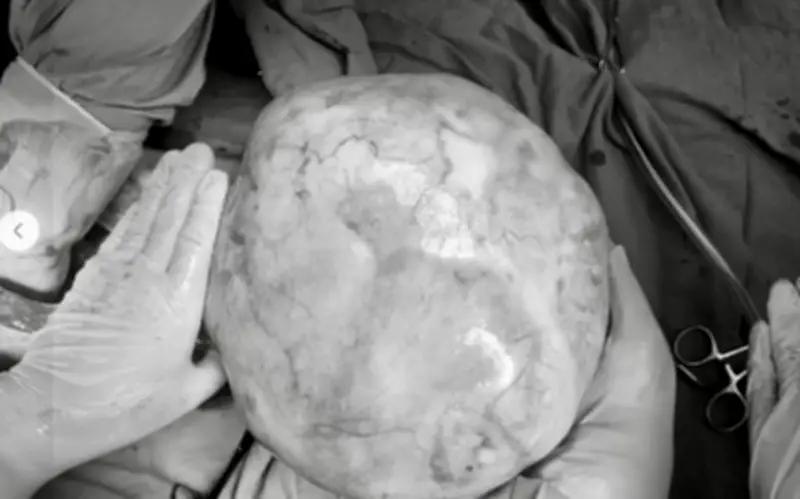 Phẫu thuật thành công khối u buồng trứng 4,3kg cho bệnh nhi 14 tuổi