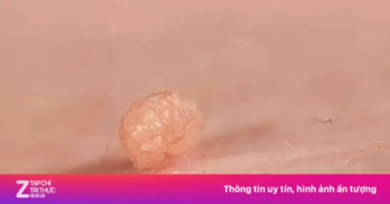 Sùi Mào Gà Có Thể Tự Khỏi Không? Bác Sĩ Da Liễu Giải Đáp Chi Tiết