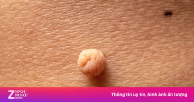 Sùi mào gà ngày càng phức tạp: Bệnh âm thầm, dễ bỏ qua và xu hướng trẻ hóa