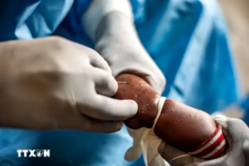 Singapore Ghi Nhận 2 Ca Lây Nhiễm Đậu Mùa Khỉ Đầu Tiên Trong Cộng Đồng