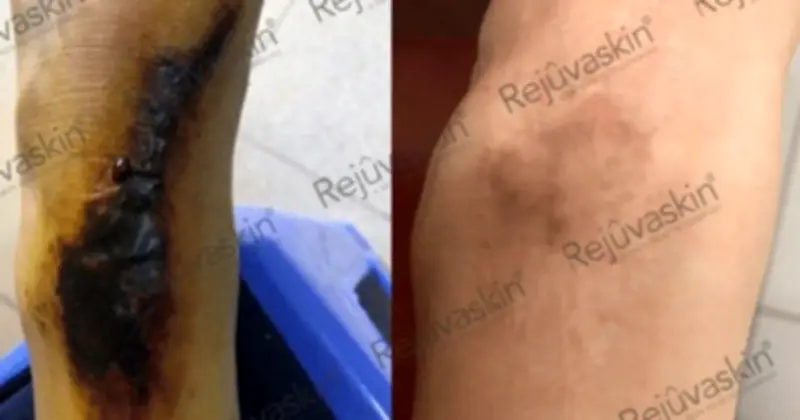 Sẹo Phì Đại Ở Khớp: Nguy Cơ Cao Và Chiến Lược Điều Trị Sớm