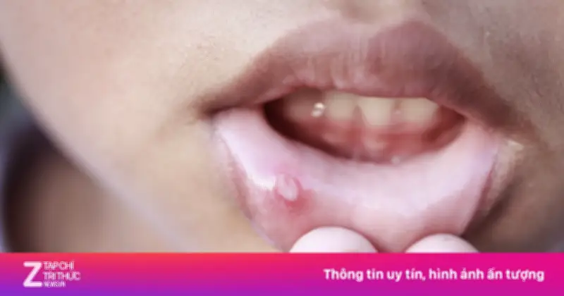 Từ nốt loét nhỏ tưởng nóng trong, người đàn ông 41 tuổi phát hiện ung thư lưỡi ác tính