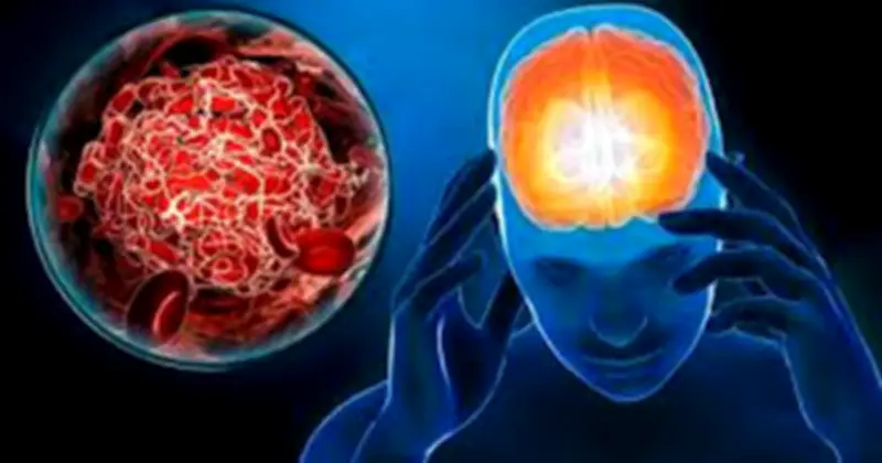 Tê tay chân không hẳn là đột quỵ: 6 dấu hiệu cảnh báo sớm dễ bị bỏ qua