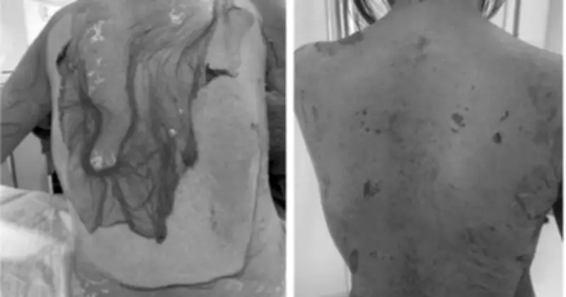 Tự ý uống thuốc dị ứng, người phụ nữ bị lột da toàn thân vì hội chứng Lyell