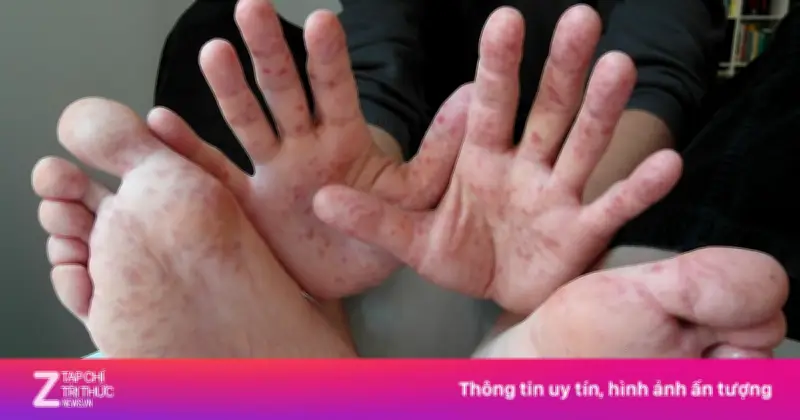 Tay chân miệng vào cao điểm: EV71 gây bệnh nặng, khi nào cần nhập viện?