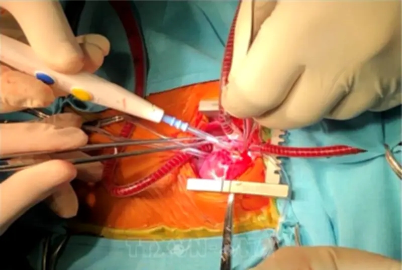 Thái Lan Thực Hiện Thành Công Ca Phẫu Thuật Tim Có Hỗ Trợ Robot Đầu Tiên