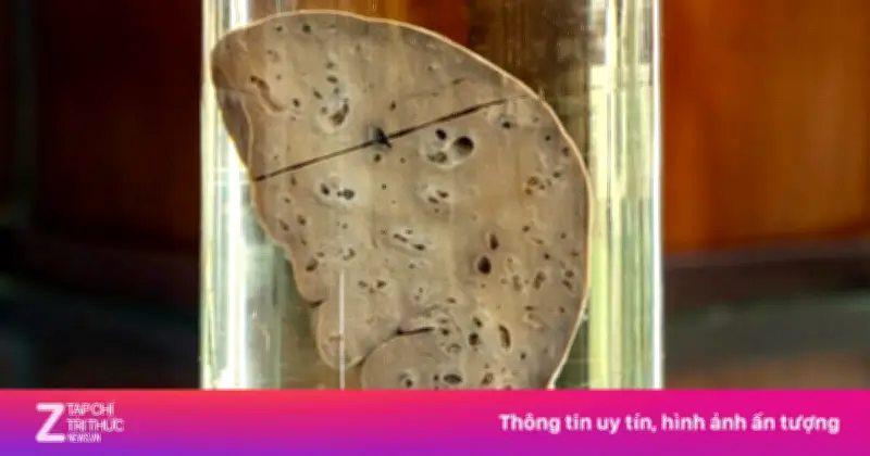 Thói quen ăn rau sống, gỏi cá: 'Sát thủ' âm thầm hủy hoại gan