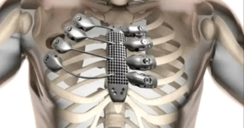 Tại sao cơ thể chấp nhận titan nhưng bài xích thép không gỉ?