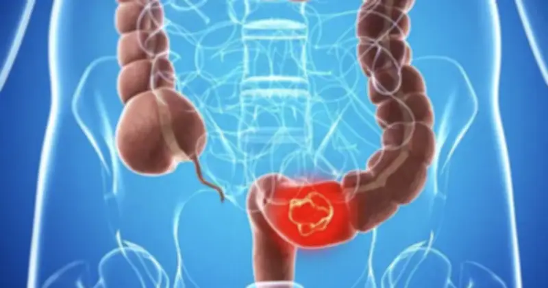 Tưởng Sống Khỏe, Bất Ngờ Ung Thư: Bài Học Từ Người Đàn Ông 45 Tuổi