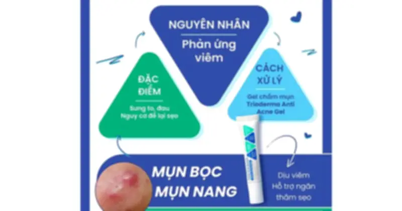 Trioderma Anti Acne Gel: Giải Mã Hiệu Quả Thực Sự Với Mụn Bọc Sau 4 Tuần