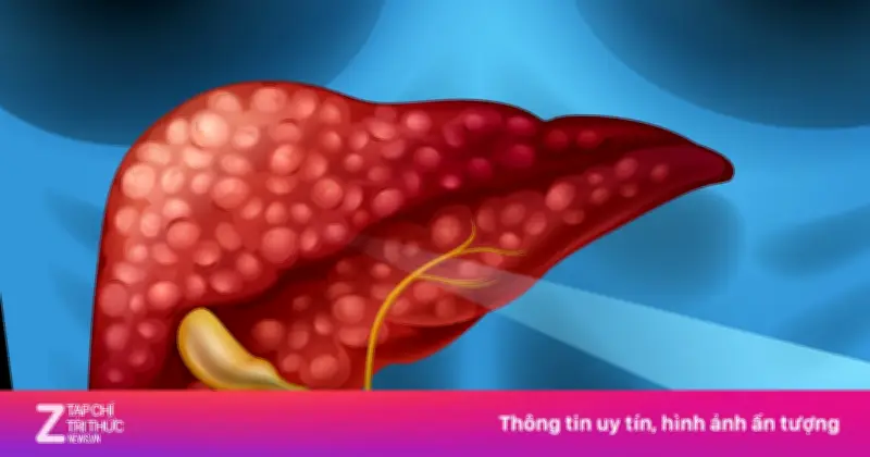 Viêm gan B: Căn bệnh 'phá gan' thầm lặng và nguy cơ xơ gan, ung thư gan