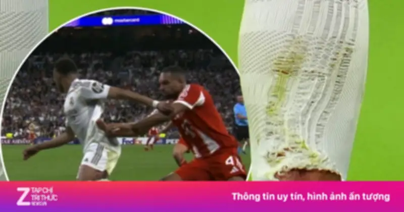 Vết thương của Mbappe sau pha vào bóng gây tranh cãi từ Tah trong trận Real Madrid thua Bayern