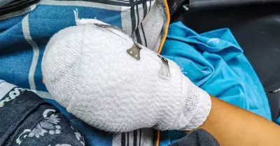 Bé trai 9 tuổi nhập viện với chấn thương nặng vùng tay bụng nghi điện thoại nổ