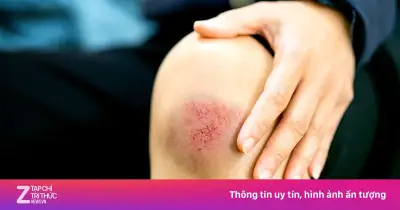 Bị trầy xước da nên ăn gì để vết thương mau lành và hạn chế sẹo?