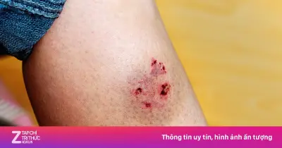 Bệnh Dại: Căn Bệnh Nghiệt Ngã Lây Từ Vết Cắn, Chưa Có Cách Chữa Khi Triệu Chứng Xuất Hiện