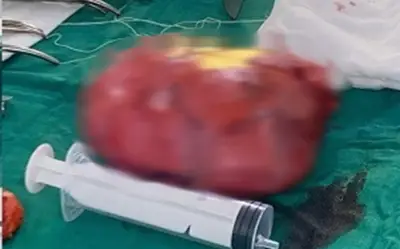 Bệnh viện Bắc Ninh phẫu thuật thành công khối u sau phúc mạc nặng gần 1 kg ở bệnh nhân cao tuổi