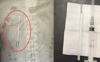 Chiếc nhiệt kế thủy ngân nằm trong bụng người đàn ông suốt 20 năm được lấy ra thành công