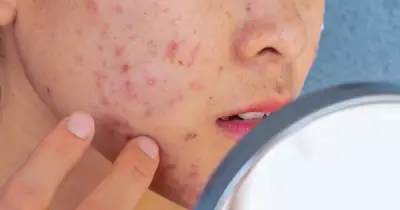 Giải Pháp Chăm Sóc Da Dầu Mụn Mùa Nắng Nóng: Chuyên Gia Chỉ Điểm Sai Lầm